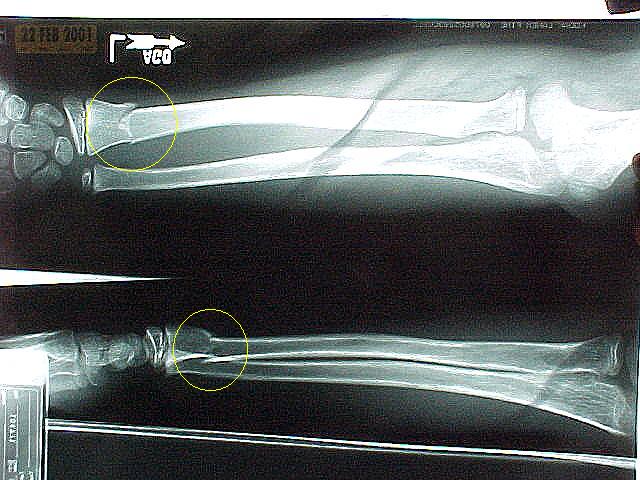 Tony's Arm.jpg (61135 bytes)